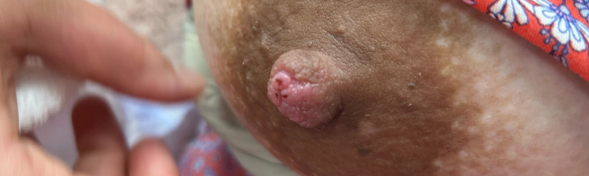 nipple damage breastfeeding woman