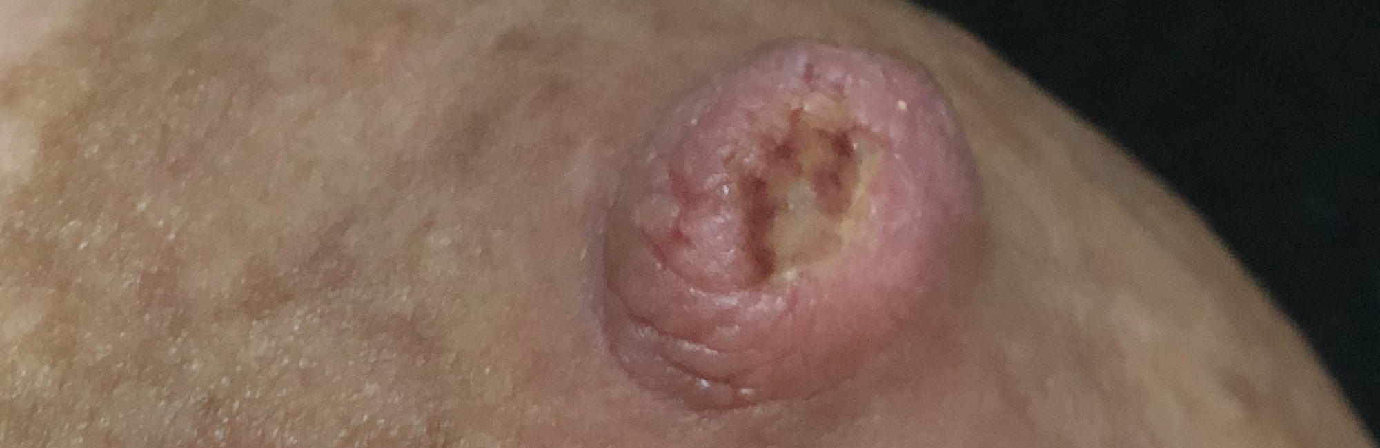 nipple wound; breastfeeding; lactation