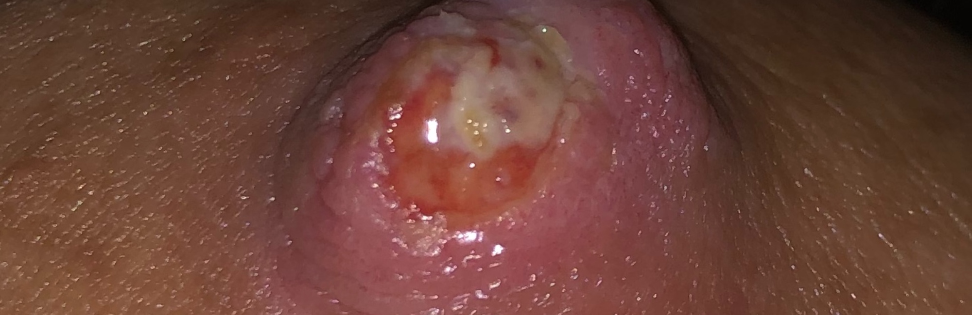 nipple pain; lactation; breastfeeding; nipple wound; 